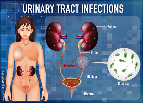 Information poster of urinary tract infections