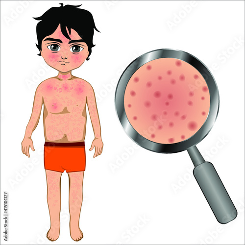 The boy's skin itches. Boy with Itches itchy blisters symptom ill with rubella. Vector illustration