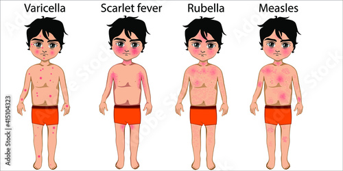 The skin of a boy with chickenpox, rubella, scarlet fever and measles. Difference between skin rashes. Vector illustration photo