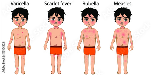 The skin of a boy with chickenpox, rubella, scarlet fever and measles. Difference between skin rashes. Vector illustration