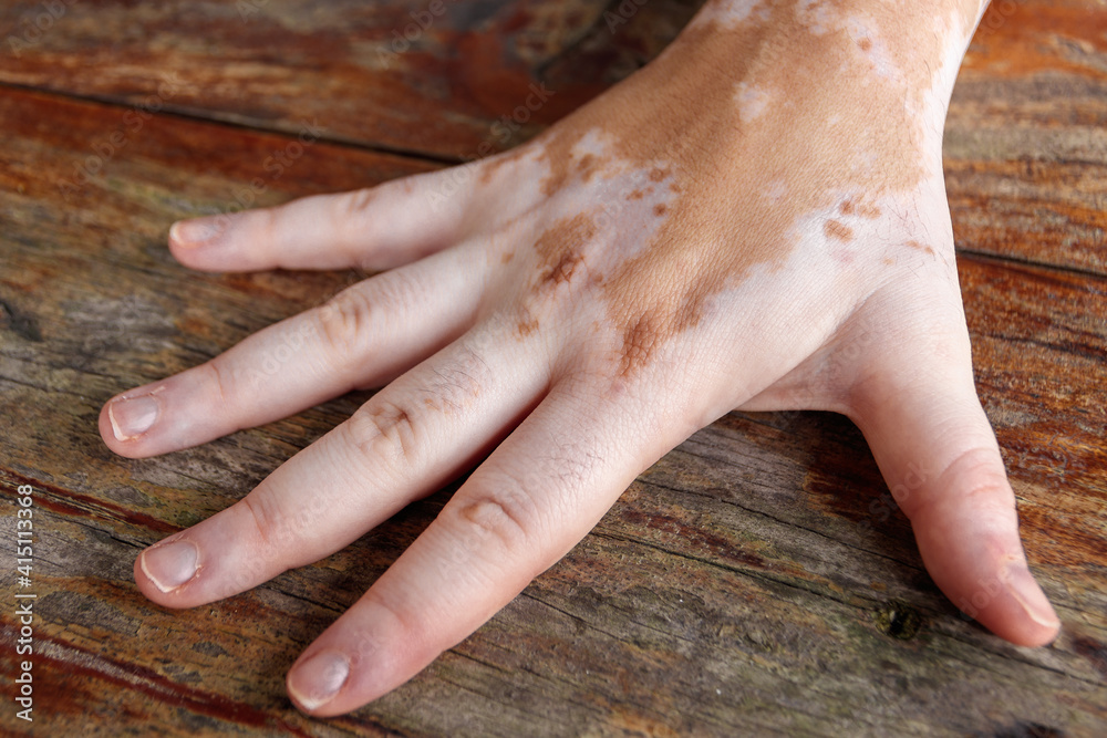 pretty hand of a woman with vitiligo pretty hand of a woman with vitiligo