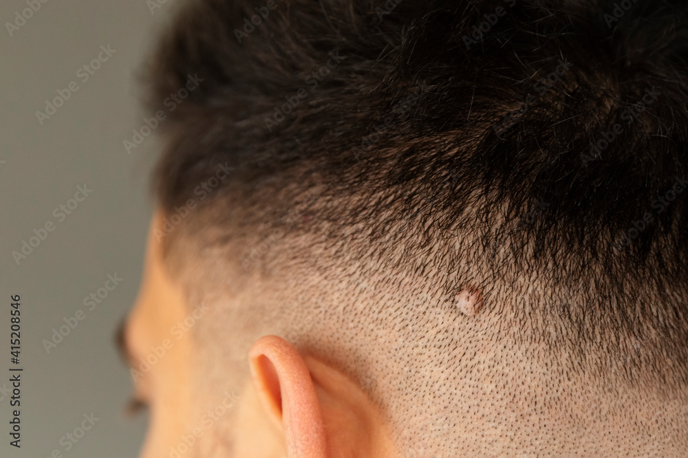 Medical examination of the danger of the patient's moles. Medical examination of the danger of the patient's moles.