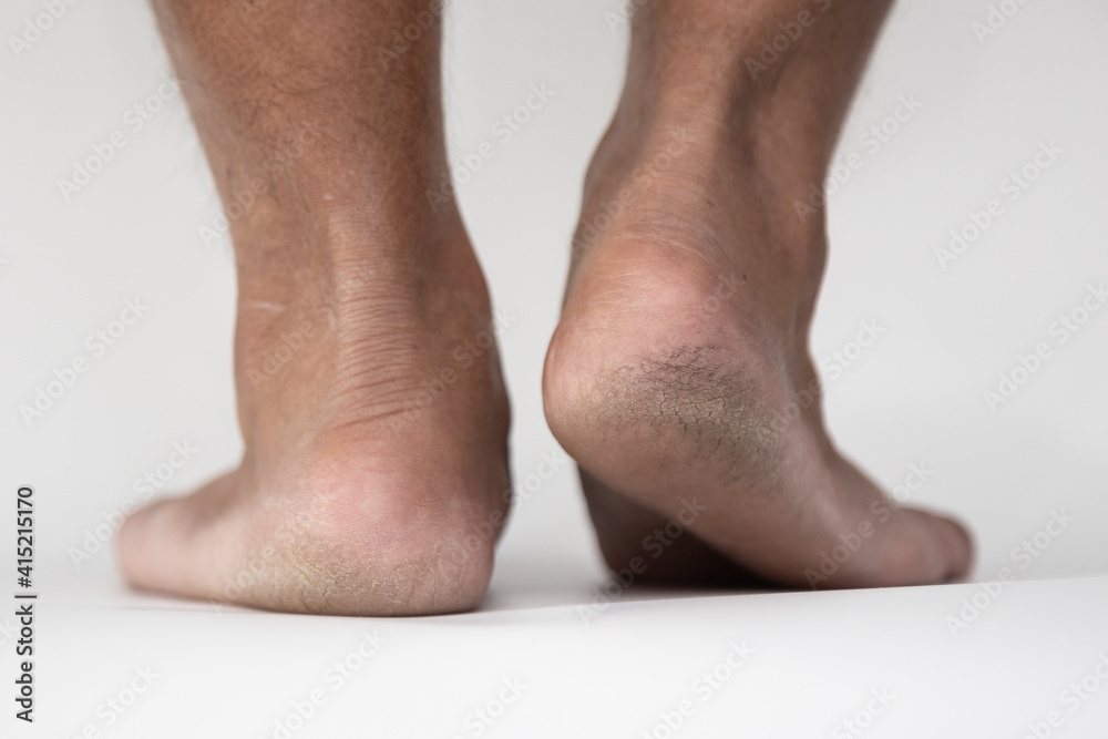 The dirty calluses feet skin, Hard foot skin.