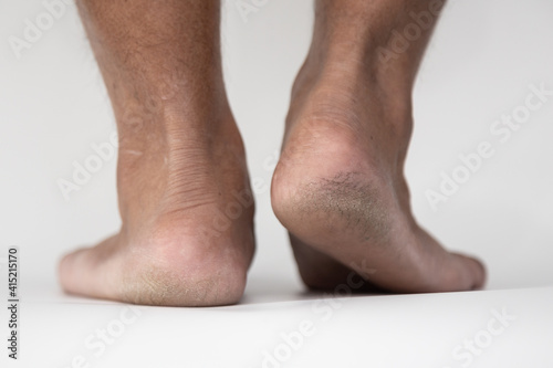 The dirty calluses feet skin, Hard foot skin. © AP focus