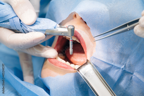 Close-up shot of attentive doctors performing surgical operation installing dental implants into patient's mouth in modern dental clinic. Dental instruments. Stomatology clinic. Dental surgery photo