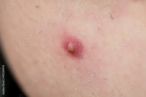 pimple on skin infection Pimple to Popping photo
