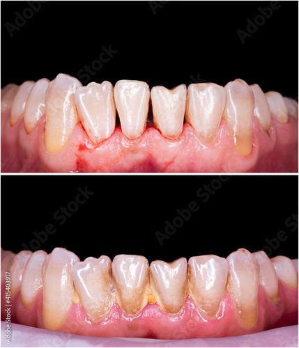 teeth cleaning before and after picture