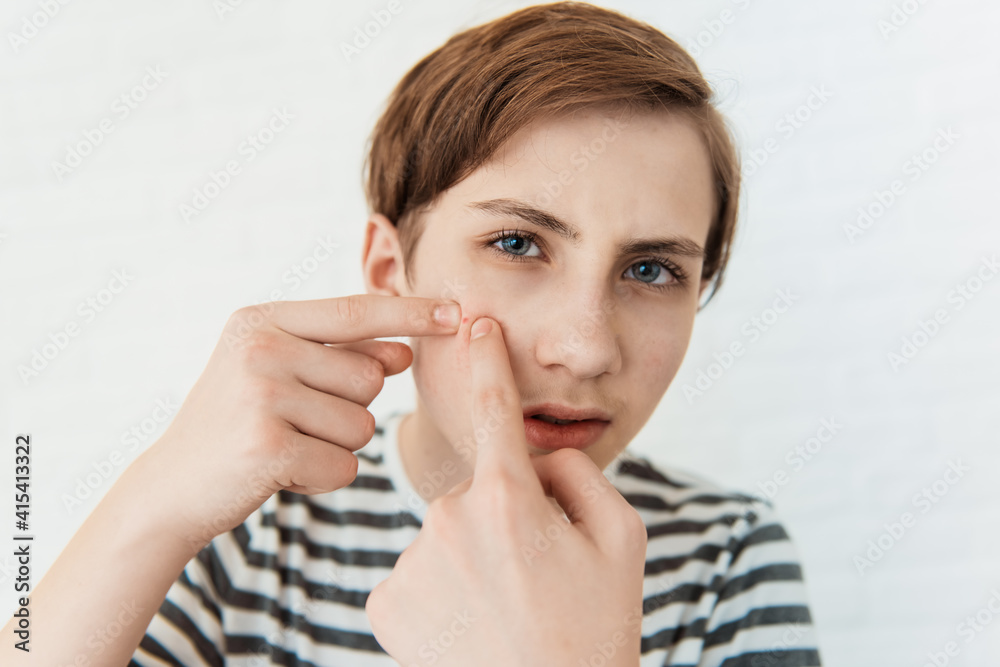 Teen boy with red pimple on on his face, closeup. Acne and skin problem Teen boy with red pimple on on his face, closeup. Acne and skin problem