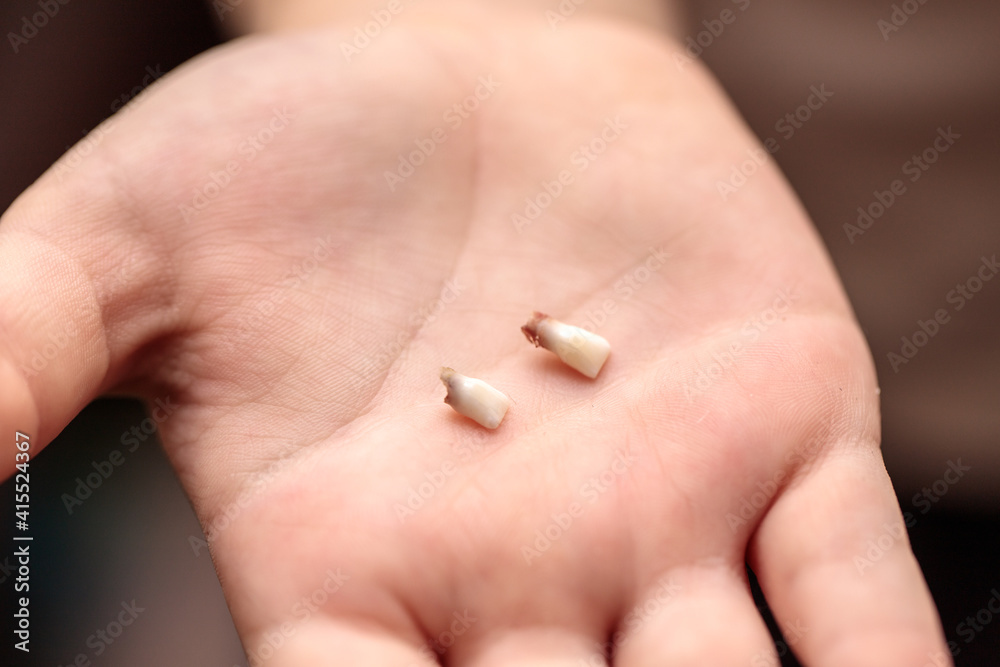 Fototapeta premium fallen milk teeth in the palm of a child. close-up
