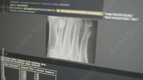 2.36 Real Neural Network Machine Learning Analyzes X-ray Bones Detecting Osteoporosis Сalcium Deficiency and Anorexia Fragility
