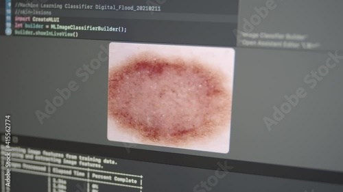 2.24 Real Neural Network Machine Learning Analyzes Skin Lesion Melanoma Cancer Detection
 photo