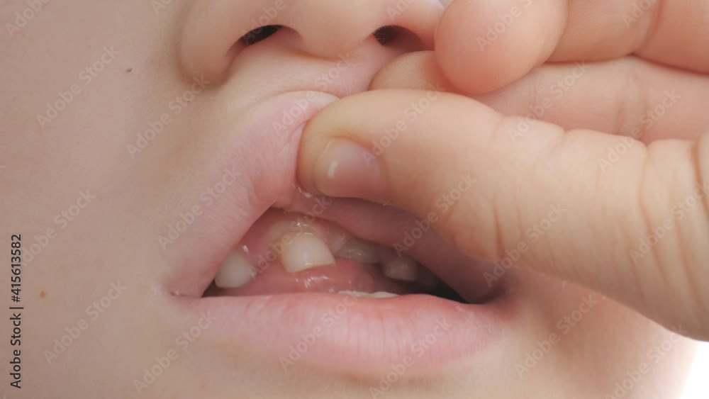 Change of baby teeth in a child. Change of baby teeth in a child.