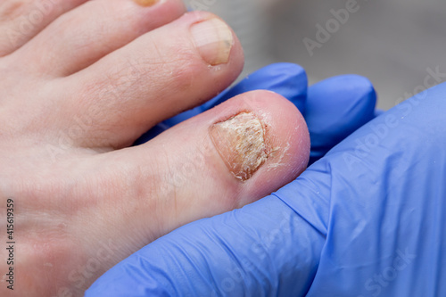 A podiatrist examines a sore foot with destroyed nails. Toenail fungus. Medical pedicure in the salon.