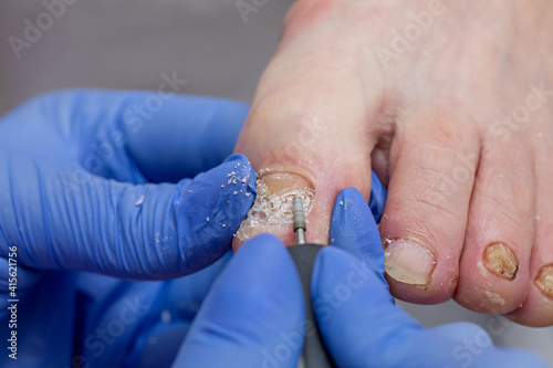 The podiatrist cuts off the damaged part of the diseased nail. 