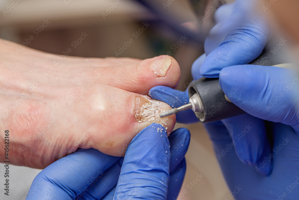 The podiatrist cuts off the damaged part of the diseased nail. The podiatrist cuts off the damaged part of the diseased nail.