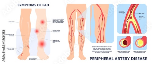 Graft artery PAD flow legs pain fatty treat hips Calf toes feet High heart ABI foot test Ankle clot injury arms stent veins Sores index attack venous ulcers blood limbs