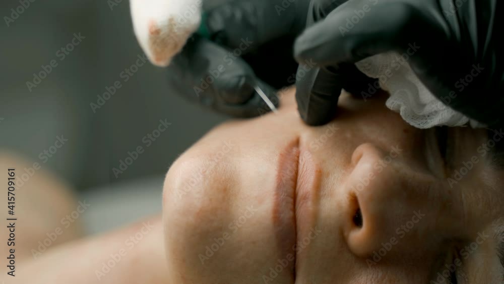 Professional cleansing of acne in a beauty salon. Facial skin care. Professional cleansing of acne in a beauty salon. Facial skin care.