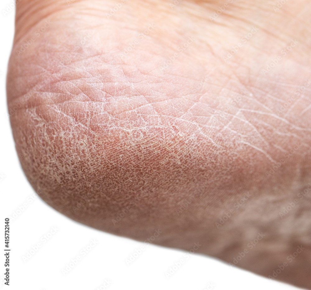 Fototapeta premium dry cracked skin on the heels of the feet