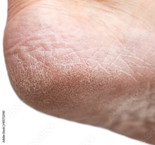 dry cracked skin on the heels of the feet