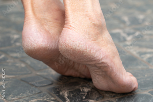 Obraz na płótnie dry cracked skin on the heels of the feet