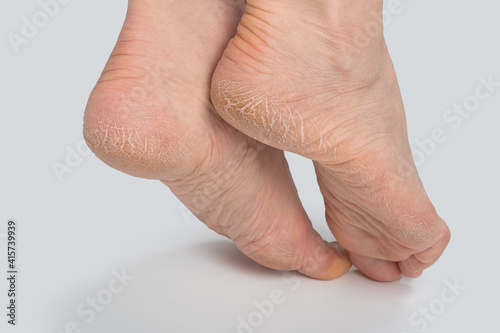 Valokuva Dry and cracked soles of feet on white background, womans feet with dry heels, c