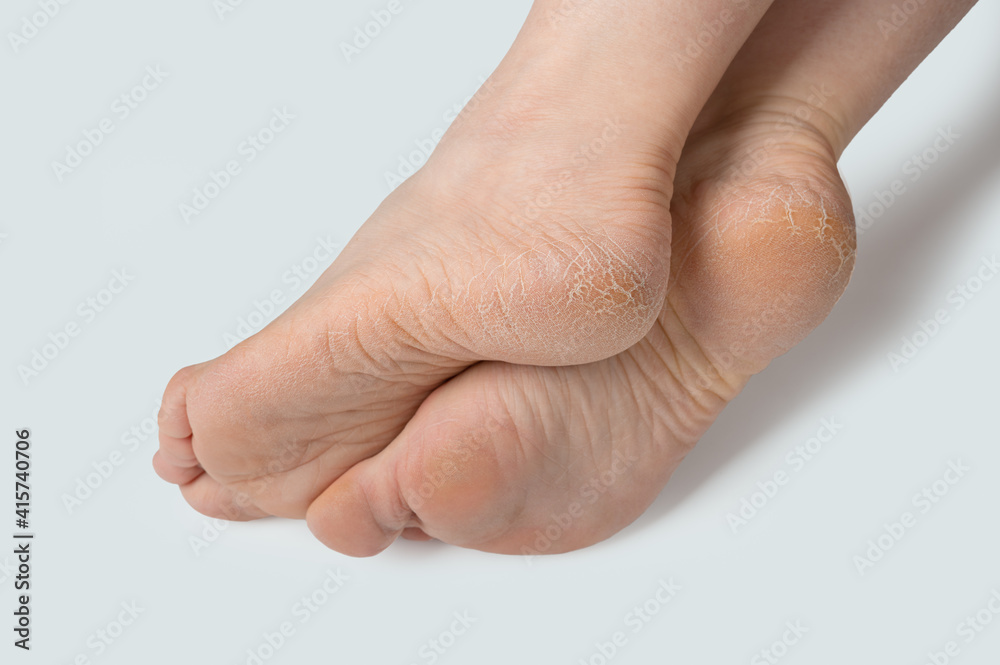 female legs, feet with dry skin on heels and soles needs care. rough skin on female feet isolated on white background female legs, feet with dry skin on heels and soles needs care. rough skin on female feet isolated on white background