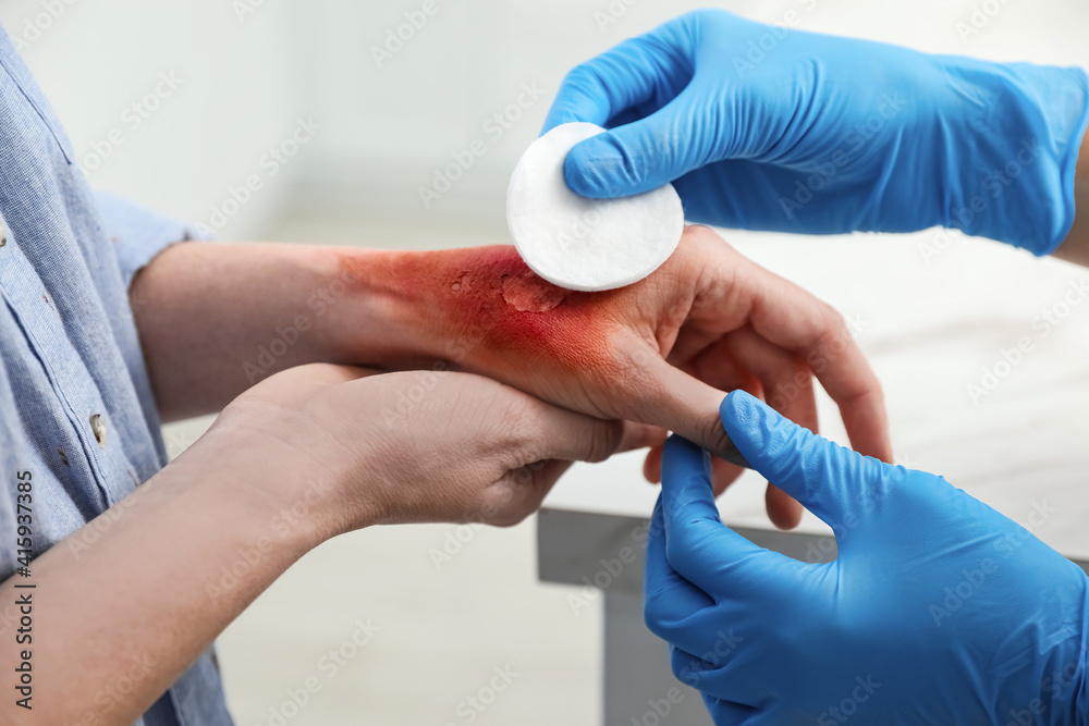 Doctor covering patient's burn of hand with cotton pad indoors, closeup Doctor covering patient's burn of hand with cotton pad indoors, closeup
