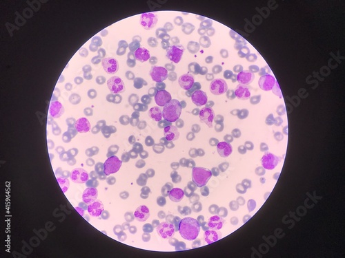Immature and mature white blood cells.Segmented neutrophil,blast cells myelocyte,metamyelocyte,Band form in blood smear,