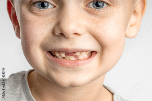 close-up of a child's face with lost front teeth