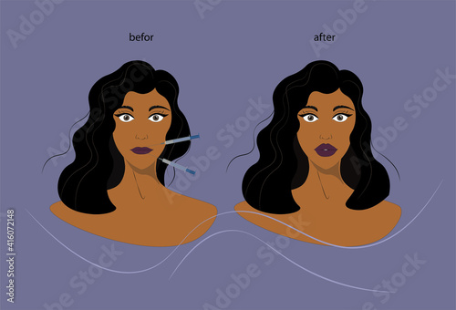 Lip augmentation. Contouring of the face. Plastic surgery. Cosmetic procedure. Injection in the lips. Correction of facial features, facial expressions.