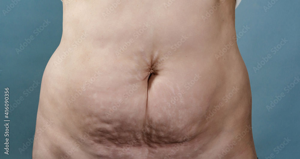 Naklejka premium Close-up of female abdomen with loose skin, stretch marks and excess skin after significant weight loss or pregnancy. Medical body concept for plastic surgery, skin tightening and postpartum care.