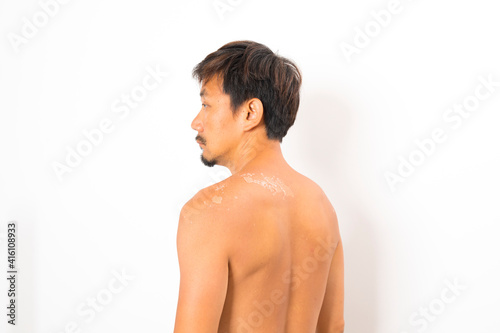 Asian man with sunburned skin and face on white background.
