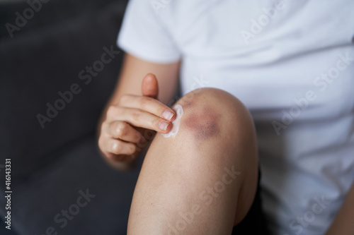 Quadro em tela Close up of a person rubbing cream for healing injured knee joint