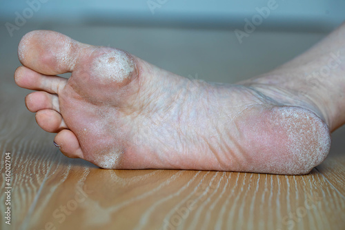 Image for medical purposes. Dry skin, plantar callosity and flakes on the female feet sole close up.