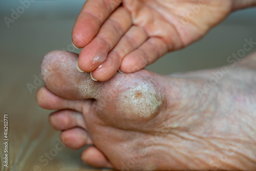 Image for medical purposes. Dry skin, plantar callosity and flakes on the female feet sole close up. Hand applying medicated ointment to sole