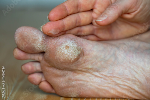 Image for medical purposes. Dry skin, plantar callosity and flakes on the female feet sole close up. Hand applying medicated ointment to sole
