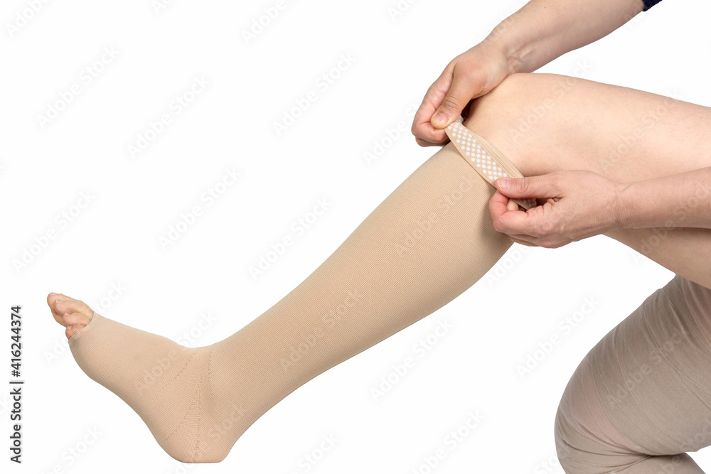 Compression garments for the treatment of lipoedema and lymphoedema. Lymphedema management: Wrapping leg using multilayer bandages to control  Lymphedema. Part of complete decongestive therapy (cdt Stock Photo