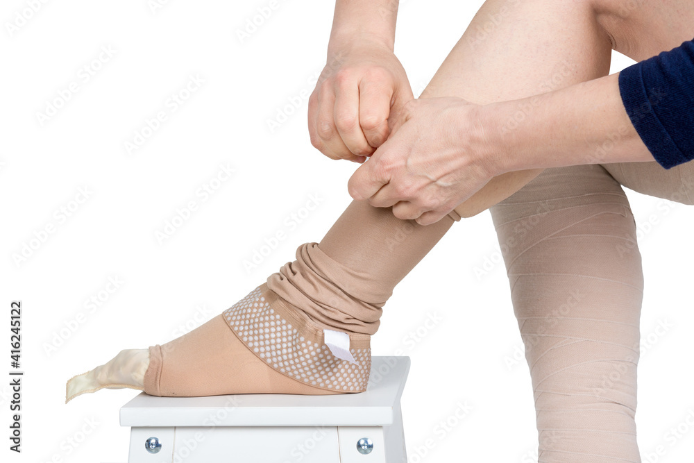 Compression garments for the treatment of lipoedema and lymphoedema