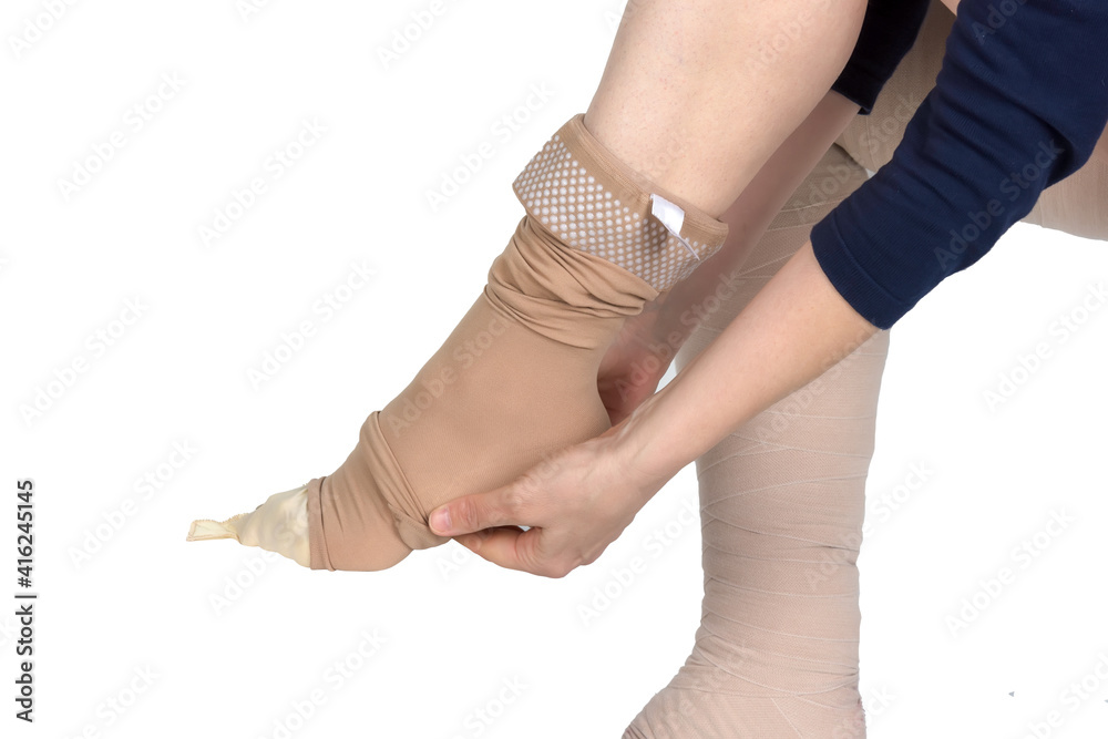 Compression garments for the treatment of lipoedema and lymphoedema. Lymphedema management: Wrapping leg using multilayer bandages to control  Lymphedema. Part of complete decongestive therapy (cdt Stock Photo