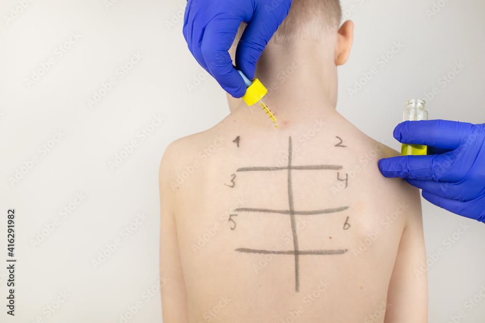 An allergist in the laboratory conducts an allergy prick-test. Skin test for household, food, epidermal allergic reactions. The test is performed on the patient's back. Child at a doctor's appointment An allergist in the laboratory conducts an allergy prick-test. Skin test for household, food, epidermal allergic reactions. The test is performed on the patient's back. Child at a doctor's appointment