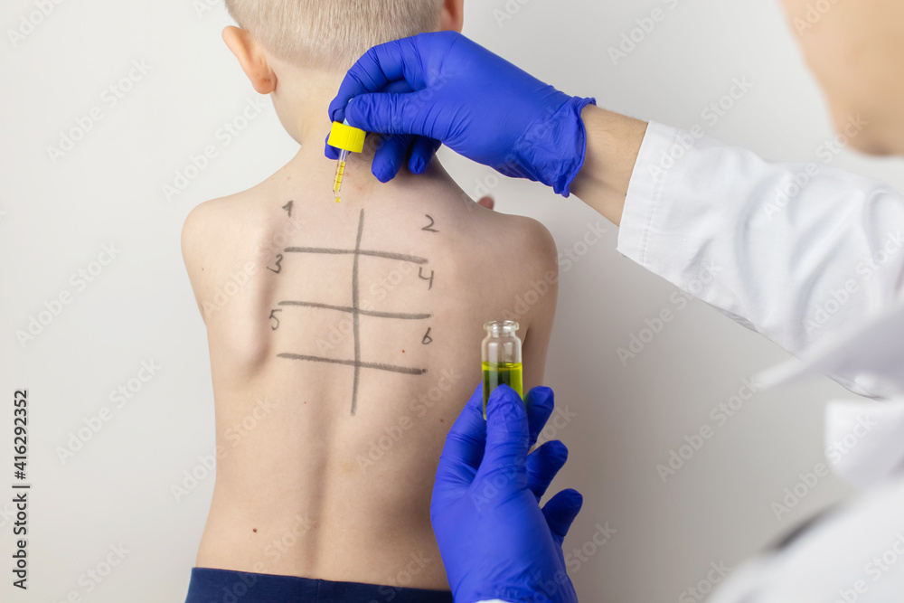 An allergist in the laboratory conducts an allergy prick-test. Skin test for household, food, epidermal allergic reactions. The test is performed on the patient's back. Child at a doctor's appointment An allergist in the laboratory conducts an allergy prick-test. Skin test for household, food, epidermal allergic reactions. The test is performed on the patient's back. Child at a doctor's appointment