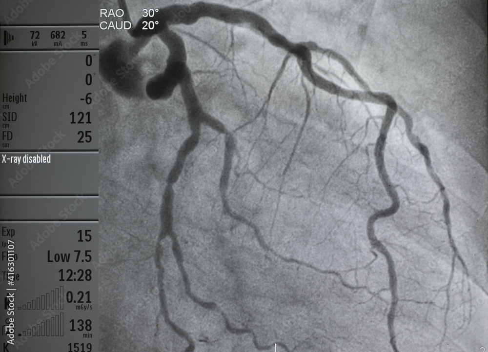 Coronary Angiography Anatomy Ppt EHTN Coronary Angiography Anatomy Ppt EHTN