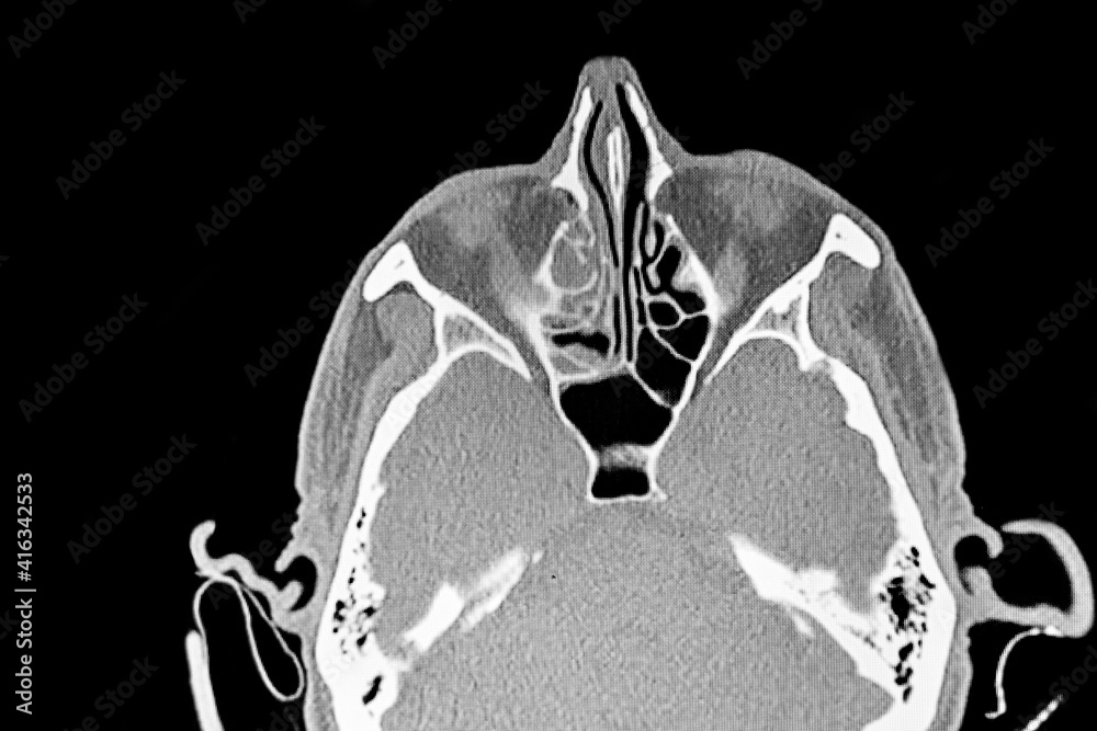 Sinus SCAN of patient with sinus infection. Medical themes