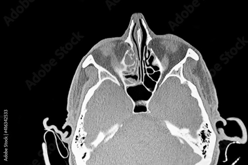 Obraz na płótnie Sinus SCAN of patient with sinus infection. Medical themes w salonie