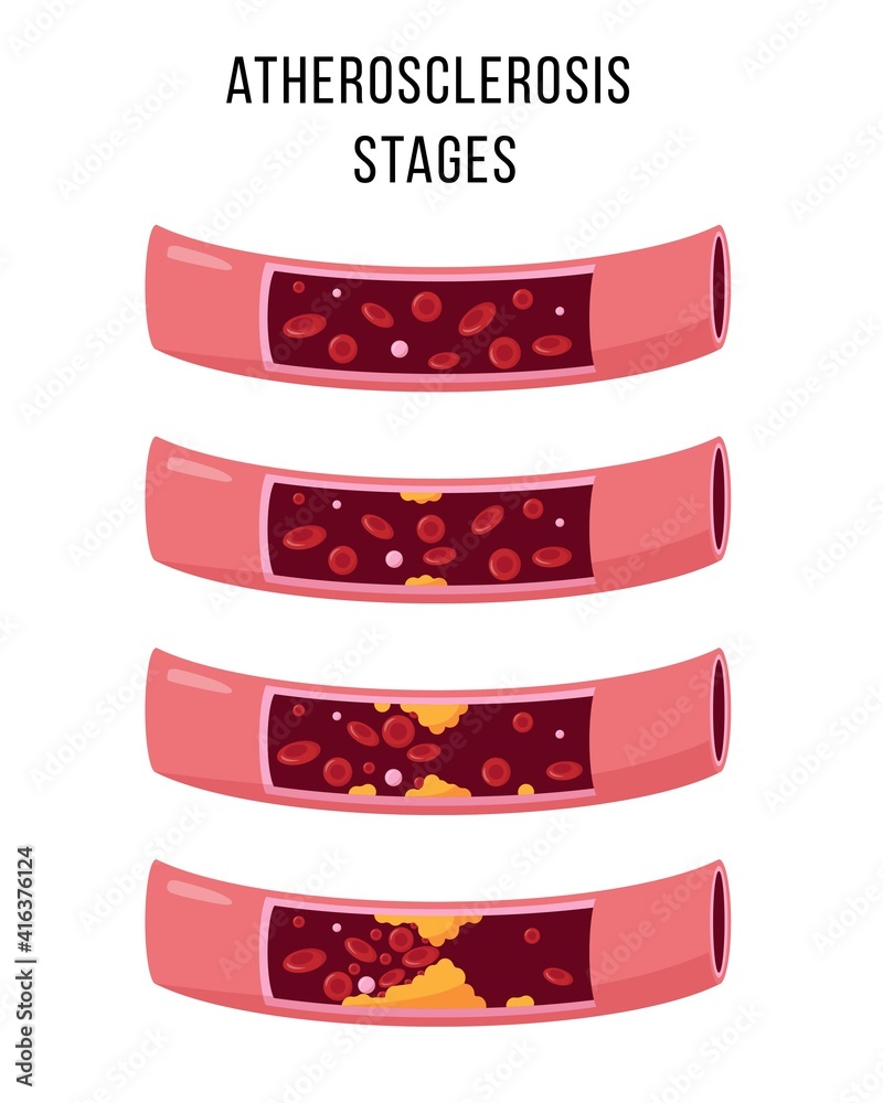 Atherosclerosis stages. Healthy and unhealthy arteries. Stock
