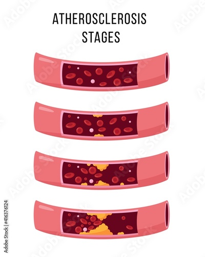 Atherosclerosis stages. Healthy and unhealthy arteries. photo