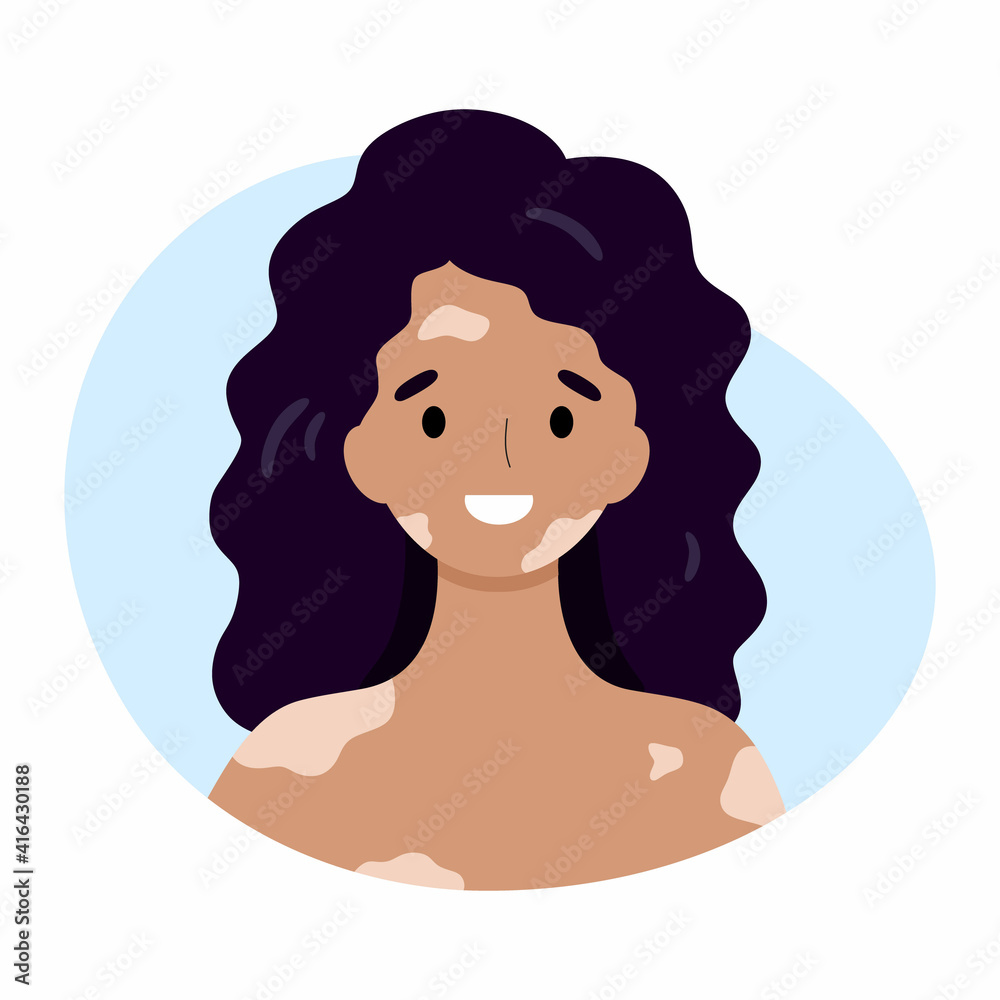 A happy woman with vitiligo. The girl suffers from problems with the skin of the face and body. A happy woman with vitiligo. The girl suffers from problems with the skin of the face and body.