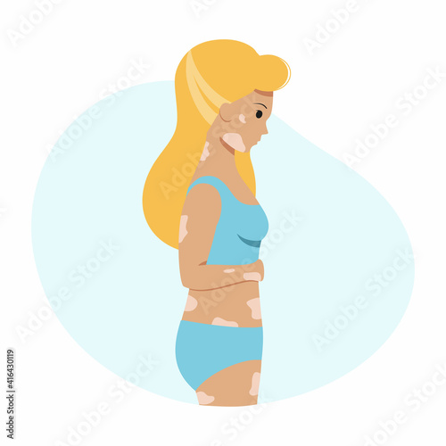 A girl with vitiligo on her skin. A woman with a pigmentation spot and a swimsuit. Vector character in a flat style .