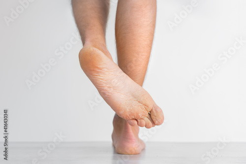 Mans showing his dry feet. Peeling and cracked foot. Fungal infection or athlete's foot, dry skin, dermatitis, eczema, psoriasis, sweaty feet or dehydration. Health care concept photo