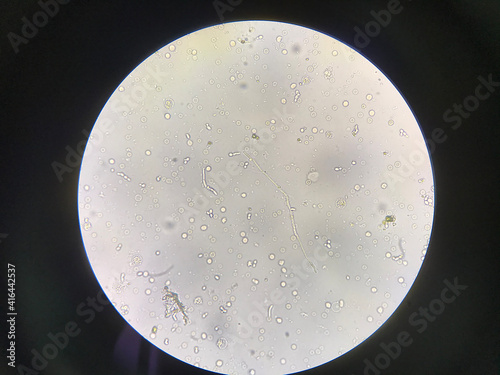 Fungus infection show budding yeast cells and pheudohyphae in urine. photo